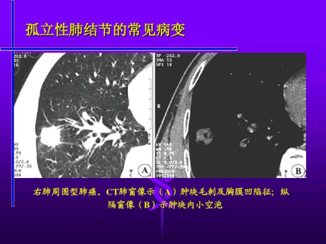 肺部结节 肺部结节