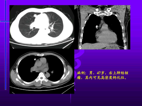 肺部结节 肺部结节