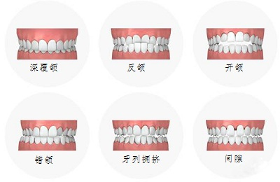 成年人做牙齿矫正效果好不好？效果好不好取决于医生的治疗方案以及患者个人的配合度。