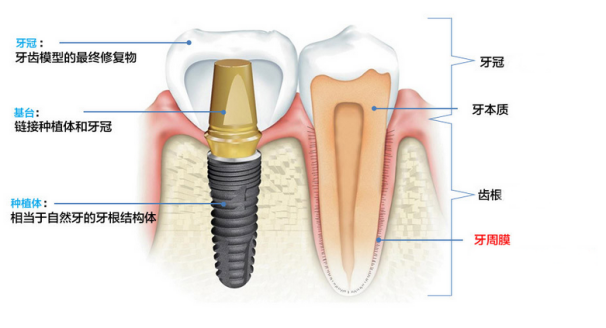 牙齿缺失去做种植牙好不好？种植牙有什么好处呢？