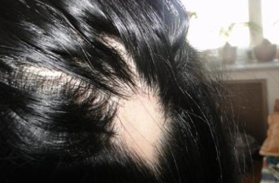 如何判断斑秃是假性的，假性斑秃能长出头发吗