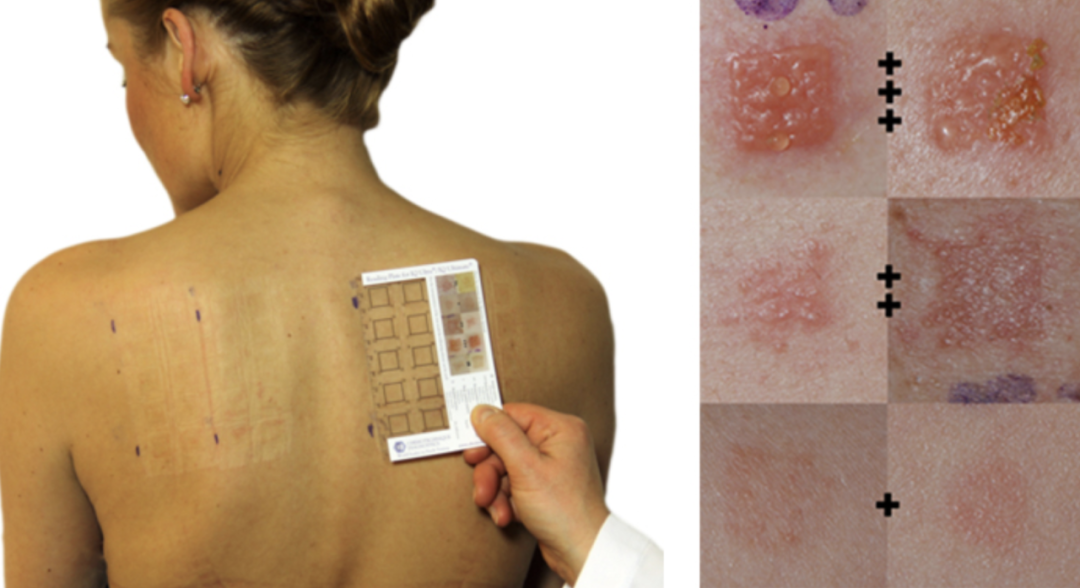 牙科光固化机是什么光患者齿科术后突发过敏，竟是美甲惹的祸？！_https://www.jmylbn.com_新闻资讯_第8张