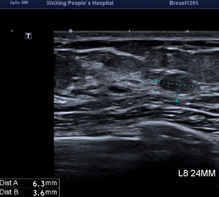 乳腺机为什么叫钼靶照完乳腺B超，为什么还要照钼靶？_https://www.jmylbn.com_新闻资讯_第6张