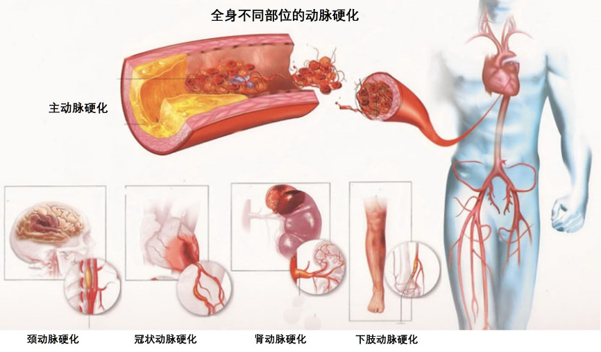 主动脉硬化怎样治疗