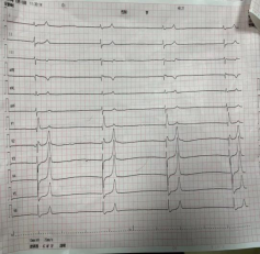 床旁x怎么使用含山县人民医院成功独立完成首例床旁经颈静脉漂浮电极心脏临时起搏器植入术！_https://www.jmylbn.com_新闻资讯_第4张