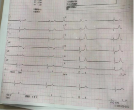 床旁x怎么使用含山县人民医院成功独立完成首例床旁经颈静脉漂浮电极心脏临时起搏器植入术！_https://www.jmylbn.com_新闻资讯_第3张