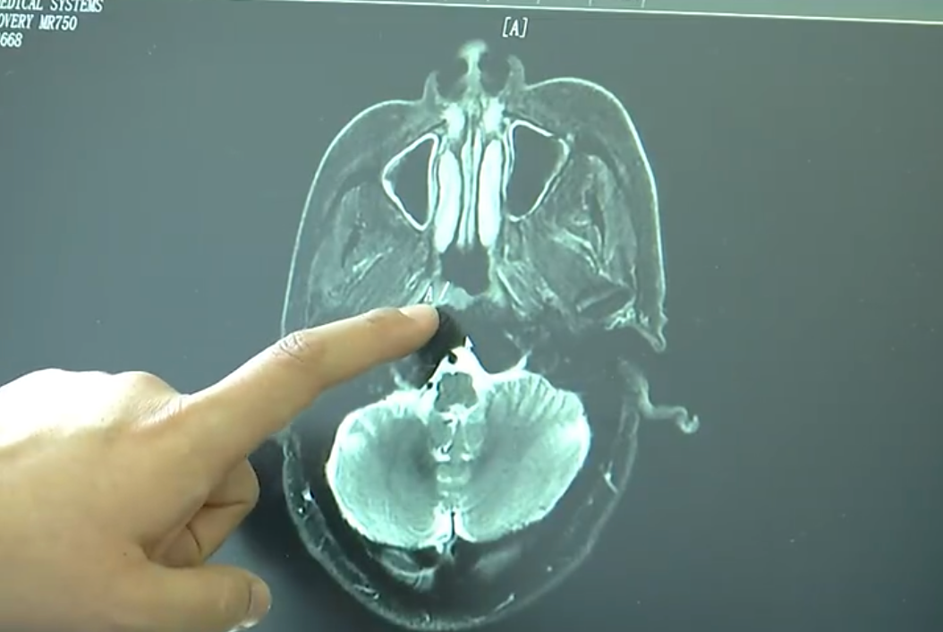 五省高发！15岁男孩患癌，只因忽视这一“小毛病”……
