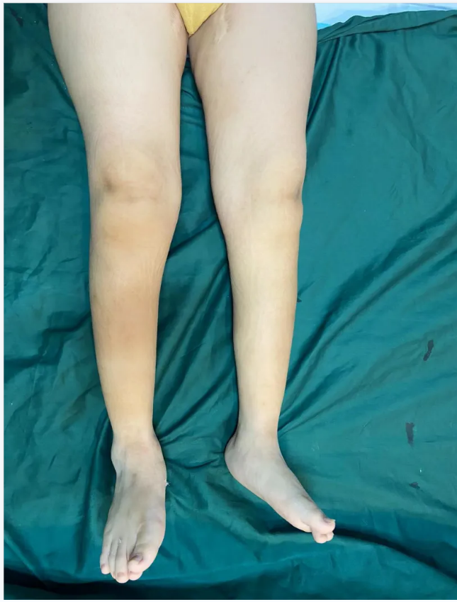 步态分析上曲线怎么解读康复科普｜常见异常步态的介绍及测试_https://www.jmylbn.com_新闻资讯_第21张