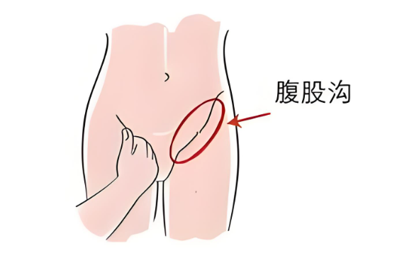 大腿根（腹股沟）疼痛：腰源性