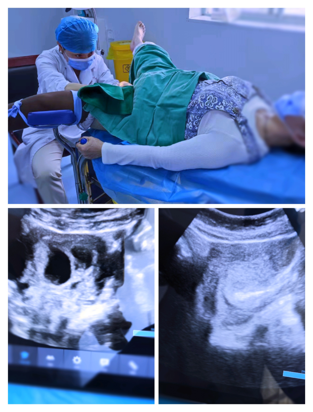 超声引导人流是什么市五院成功开展首例超声引导无痛人流术_https://www.jmylbn.com_新闻资讯_第2张