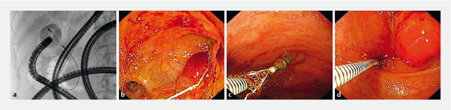 取石网篮 为什么贵四川大学华西医院消化内科胡兵团队：经内镜逆行胰胆管造影术下特殊“网篮嵌顿”案例的内镜处理一例_https://www.jmylbn.com_新闻资讯_第6张