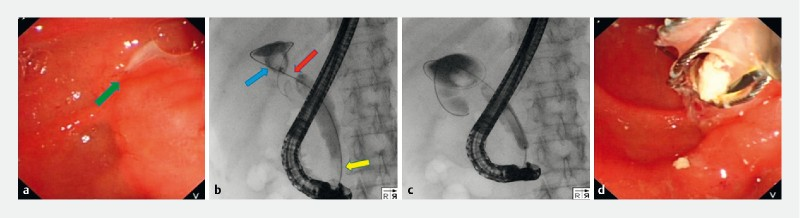 取石网篮 为什么贵四川大学华西医院消化内科胡兵团队：经内镜逆行胰胆管造影术下特殊“网篮嵌顿”案例的内镜处理一例_https://www.jmylbn.com_新闻资讯_第5张