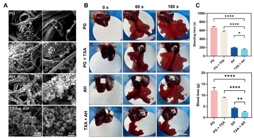 骨科用哪些止血纱华西医院骨科／骨科研究所沈彬／曾羿团队：氨甲环酸联合可吸收止血纱血液管理新策略实现“止血-抗纤溶”全覆盖，协同加速TKA术后康复_https://www.jmylbn.com_新闻资讯_第3张