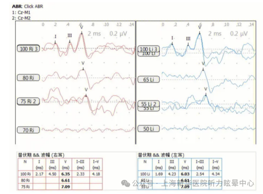 听性脑干反应检查是什么宝爸宝妈看过来，不容忽视的听性脑干反应(ABR)检查_https://www.jmylbn.com_新闻资讯_第10张
