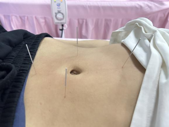 导什么针什么作用小银针大作用-关于针灸您了解多少？_https://www.jmylbn.com_新闻资讯_第3张