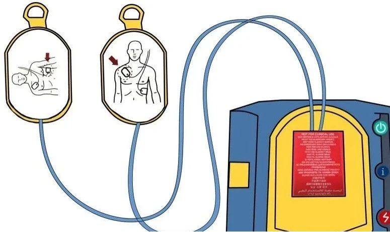 cpr按压板怎么用心肺复苏（CPR+AED）教程来啦_https://www.jmylbn.com_新闻资讯_第9张