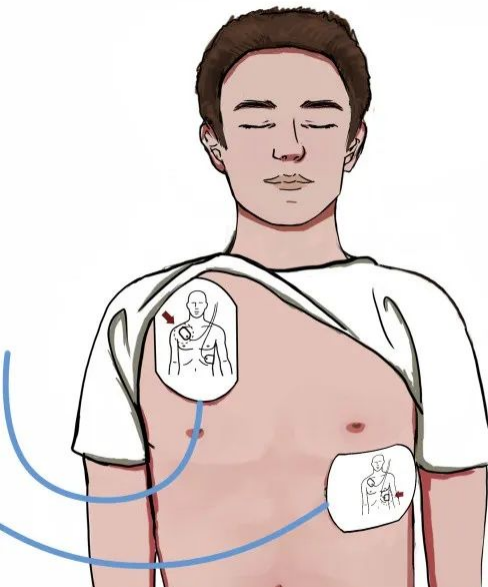 cpr按压板怎么用心肺复苏（CPR+AED）教程来啦_https://www.jmylbn.com_新闻资讯_第10张