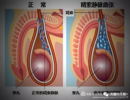 睾丸变大图片