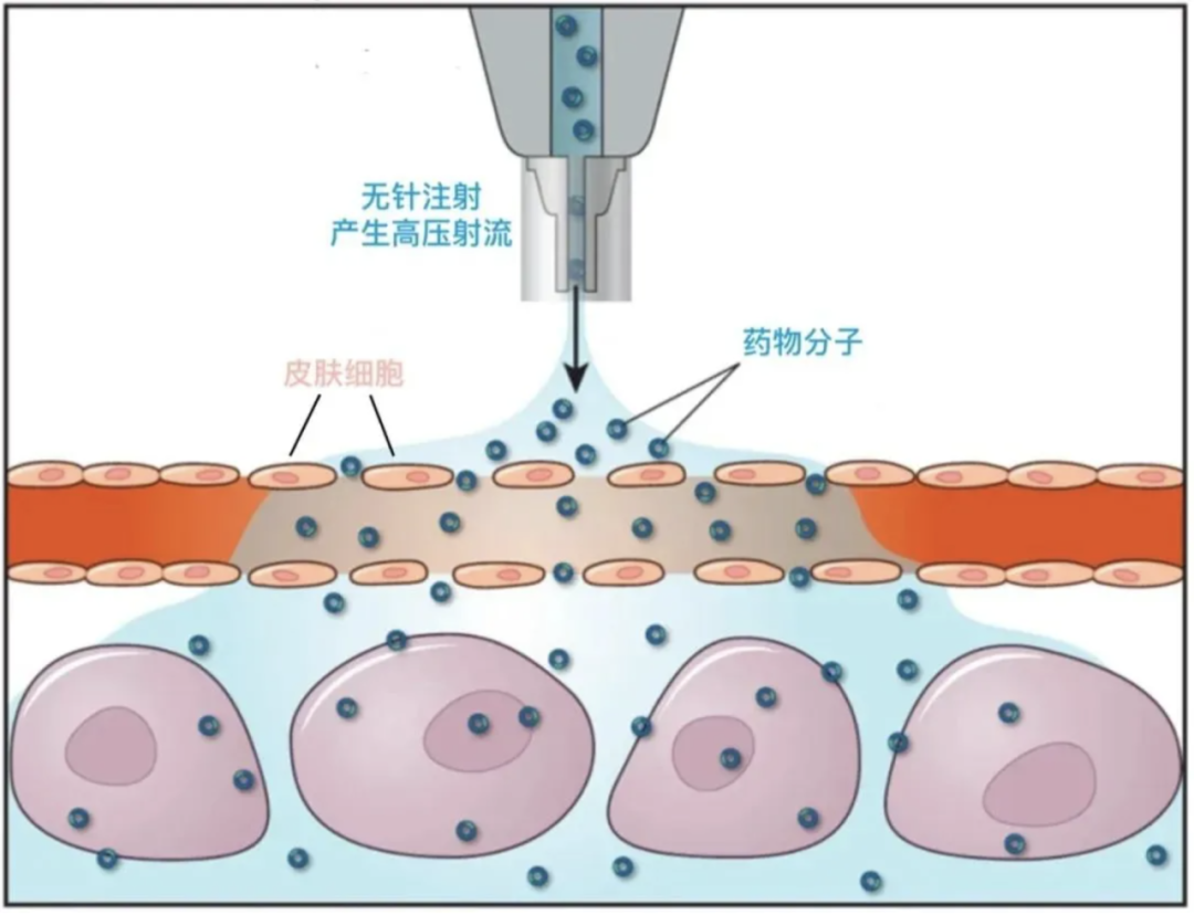 注射器怎么看毫升图独家抗糖秘笈之注射篇 ｜ 一表读懂胰岛素注射装置_https://www.jmylbn.com_新闻资讯_第23张