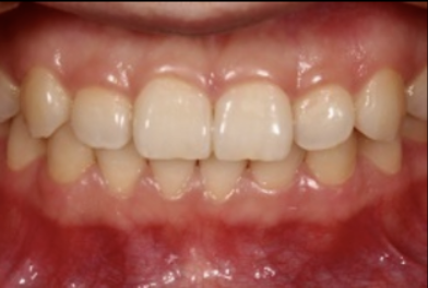 牙医看过来！正畸照片拍摄的正确姿势在这里