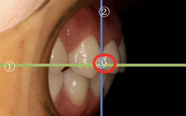 牙医看过来！正畸照片拍摄的正确姿势在这里