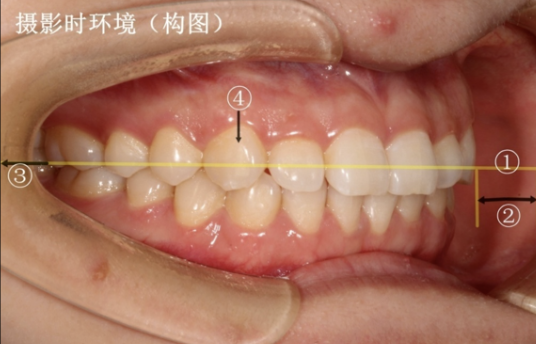牙医看过来！正畸照片拍摄的正确姿势在这里