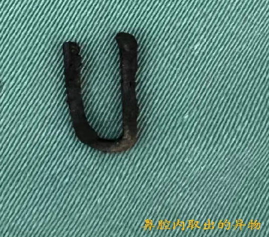 耳鼻喉内窥镜检查是检查什么【健康科普】什么是耳鼻喉内窥镜检查？_https://www.jmylbn.com_新闻资讯_第10张