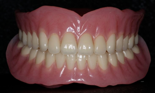 口腔吸盘怎么安装像“吸盘”一样的吸附性义齿——除种植牙外的无牙颌患者的福音！_https://www.jmylbn.com_新闻资讯_第8张