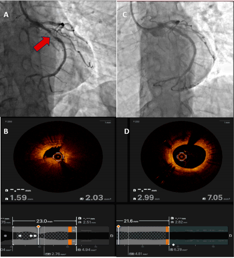 急性冠脉综合征：最新进展