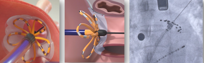 房颤脉冲消融围手术期管理：一例术后溶血病例的临床启示