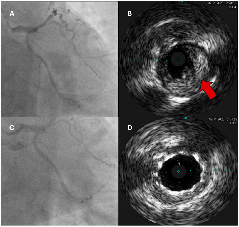 急性冠脉综合征：最新进展