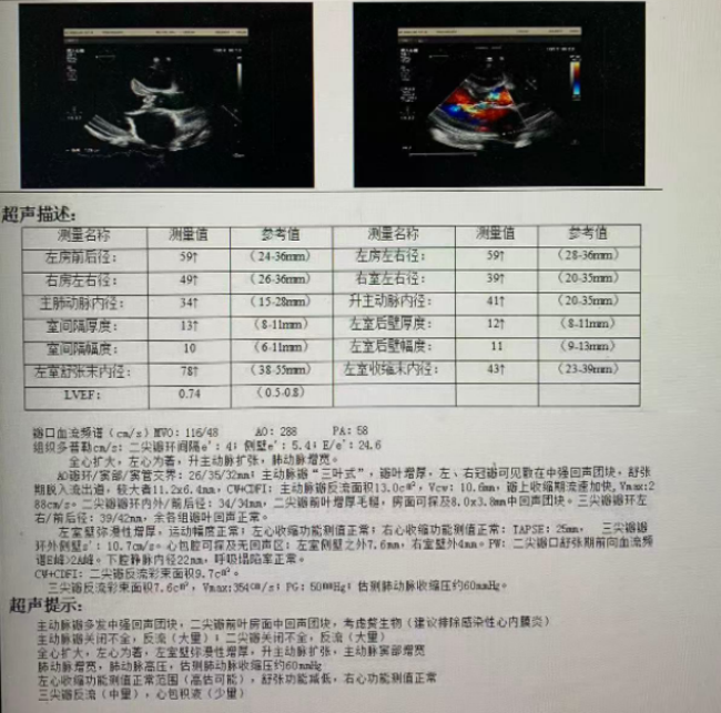 IE导致的冠脉栓塞：一例非动脉粥样硬化性心肌梗死的诊疗启示