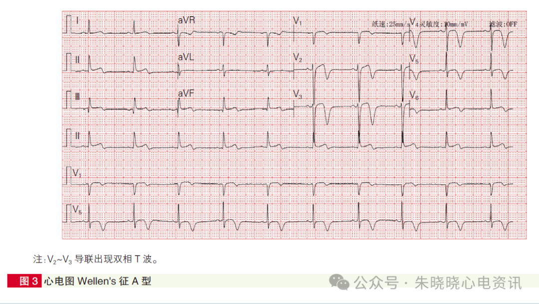 心肌梗死心电图诊断标准和报告规范中国专家共识