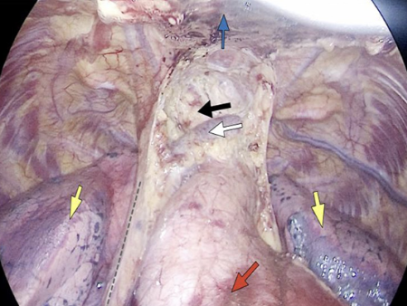 外科拉勾怎么拉【赣医精术】“钥匙孔”里的高精操作！我院胸外科成功开展全市首例胸骨拉钩辅助剑突下单孔全胸腺切除术_https://www.jmylbn.com_新闻资讯_第9张