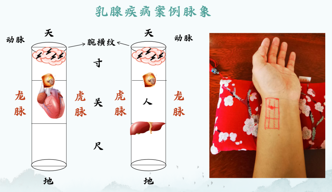 为什么要定位针 乳腺摸得清、说得准、治得好、好得快——如龙古脉针药并治乳腺疾病经验分享_https://www.jmylbn.com_新闻资讯_第6张