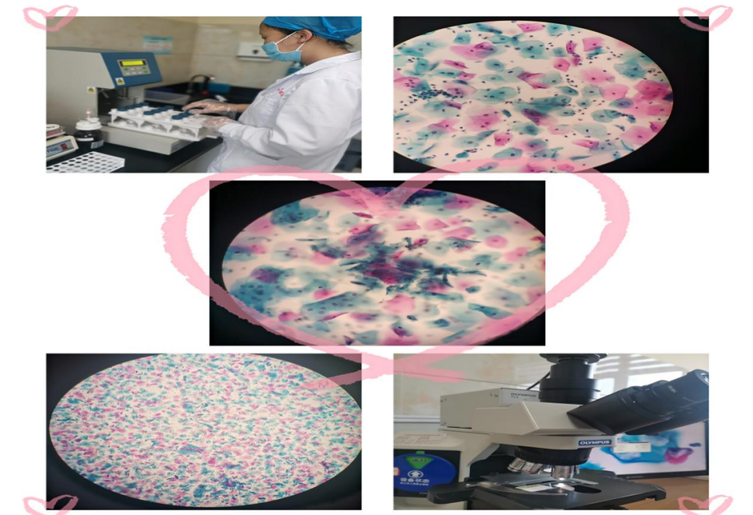 细胞制片夹怎么用知否知否，宫颈癌筛查有它相守    知否知否，预防“红颜杀手”_https://www.jmylbn.com_新闻资讯_第9张