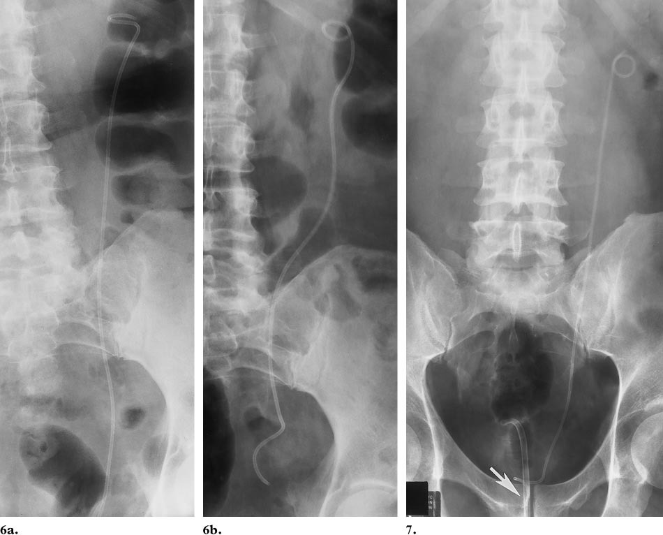 猪输尿管怎么吃关于双“J”管，带你认识不一样的“猪尾巴”_https://www.jmylbn.com_新闻资讯_第10张