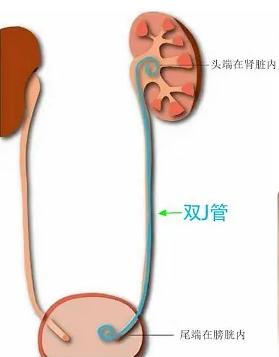 猪输尿管怎么吃关于双“J”管，带你认识不一样的“猪尾巴”_https://www.jmylbn.com_新闻资讯_第4张