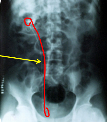 猪输尿管怎么吃关于双“J”管，带你认识不一样的“猪尾巴”_https://www.jmylbn.com_新闻资讯_第5张