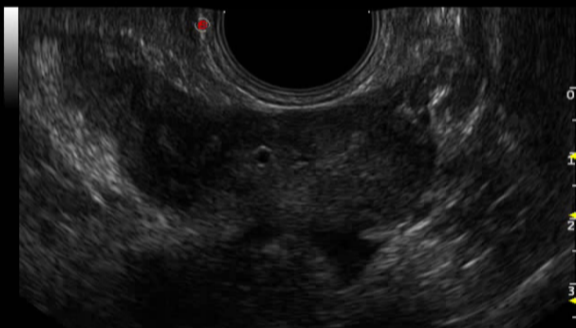 百胜彩超怎么样【州医先进设备】精准诊断引领精准治疗（十）——介入超声新利器，百胜MyLab 9引领精准医疗_https://www.jmylbn.com_新闻资讯_第11张