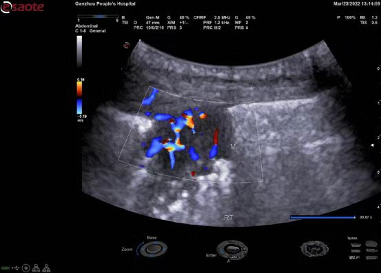 百胜彩超怎么样【州医先进设备】精准诊断引领精准治疗（十）——介入超声新利器，百胜MyLab 9引领精准医疗_https://www.jmylbn.com_新闻资讯_第12张