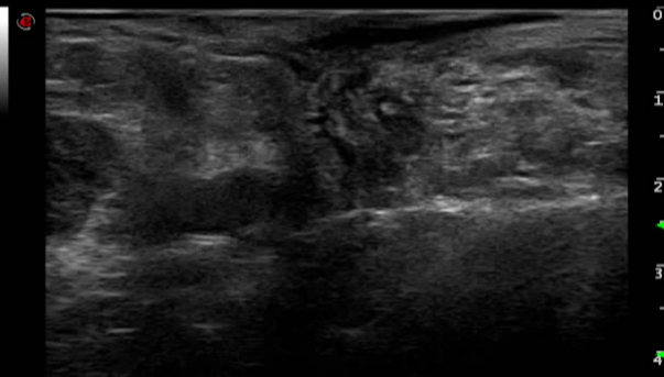 百胜彩超怎么样【州医先进设备】精准诊断引领精准治疗（十）——介入超声新利器，百胜MyLab 9引领精准医疗_https://www.jmylbn.com_新闻资讯_第10张