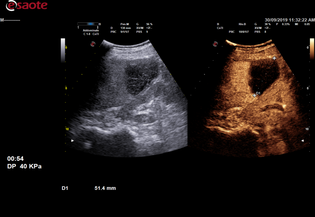 百胜彩超怎么样【州医先进设备】精准诊断引领精准治疗（十）——介入超声新利器，百胜MyLab 9引领精准医疗_https://www.jmylbn.com_新闻资讯_第7张