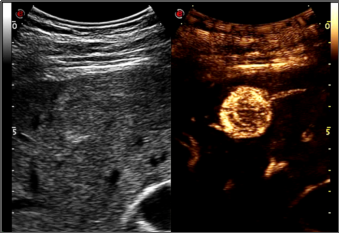 百胜彩超怎么样【州医先进设备】精准诊断引领精准治疗（十）——介入超声新利器，百胜MyLab 9引领精准医疗_https://www.jmylbn.com_新闻资讯_第6张