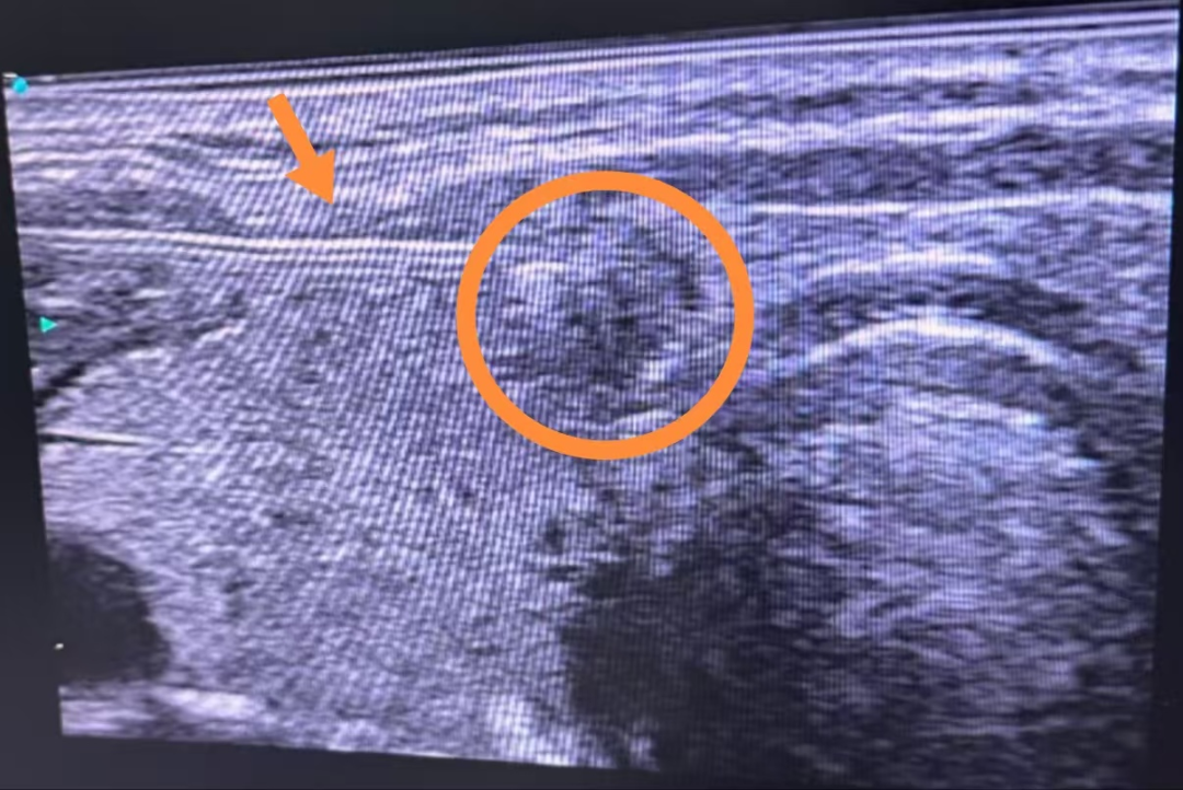 汕头彩超怎么样精准诊断，护航健康——甘南州人民医院普外科用汕头超声（SIUI）便携式彩超仪常规开展超声引导下甲状腺穿刺活检术（FNA）_https://www.jmylbn.com_新闻资讯_第3张