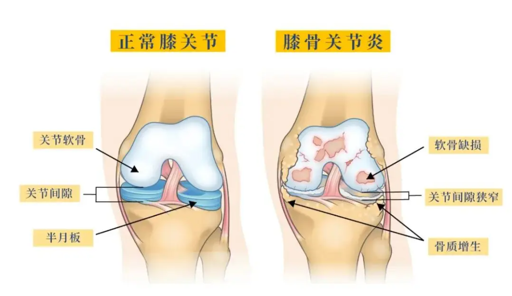 为什么买关节镜膝盖“咔咔响”、上下楼疼？一文读懂膝骨关节炎，不是“老寒腿”那么简单！_https://www.jmylbn.com_新闻资讯_第4张