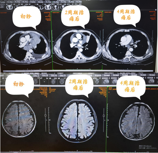 隔物灸有什么作用【顽症有解】规范诊疗+中西医结合，为小细胞肺癌患者点亮希望之光_https://www.jmylbn.com_新闻资讯_第11张