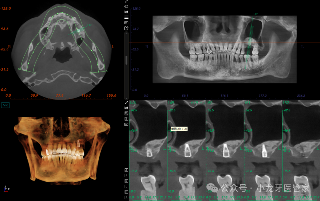 病例分享：上颌窦外提升术一例
