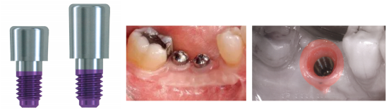 愈合机台怎么识别型号愈合基台的定义、分类、特点和临床选择,一文详解_新闻资讯_第11张_活检穿刺产品网 愈合机台怎么识别型号愈合基台的定义、分类、特点和临床选择,一文详解_https://www.jmylbn.com_新闻资讯_第11张