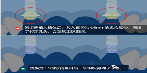 愈合机台怎么识别型号愈合基台的定义、分类、特点和临床选择，一文详解_https://www.jmylbn.com_新闻资讯_第22张
